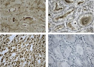 Gastrin-Releasing Peptide Receptor in Low Grade Prostate Cancer: Can It Be a Better Predictor Than Prostate-Specific Membrane Antigen?